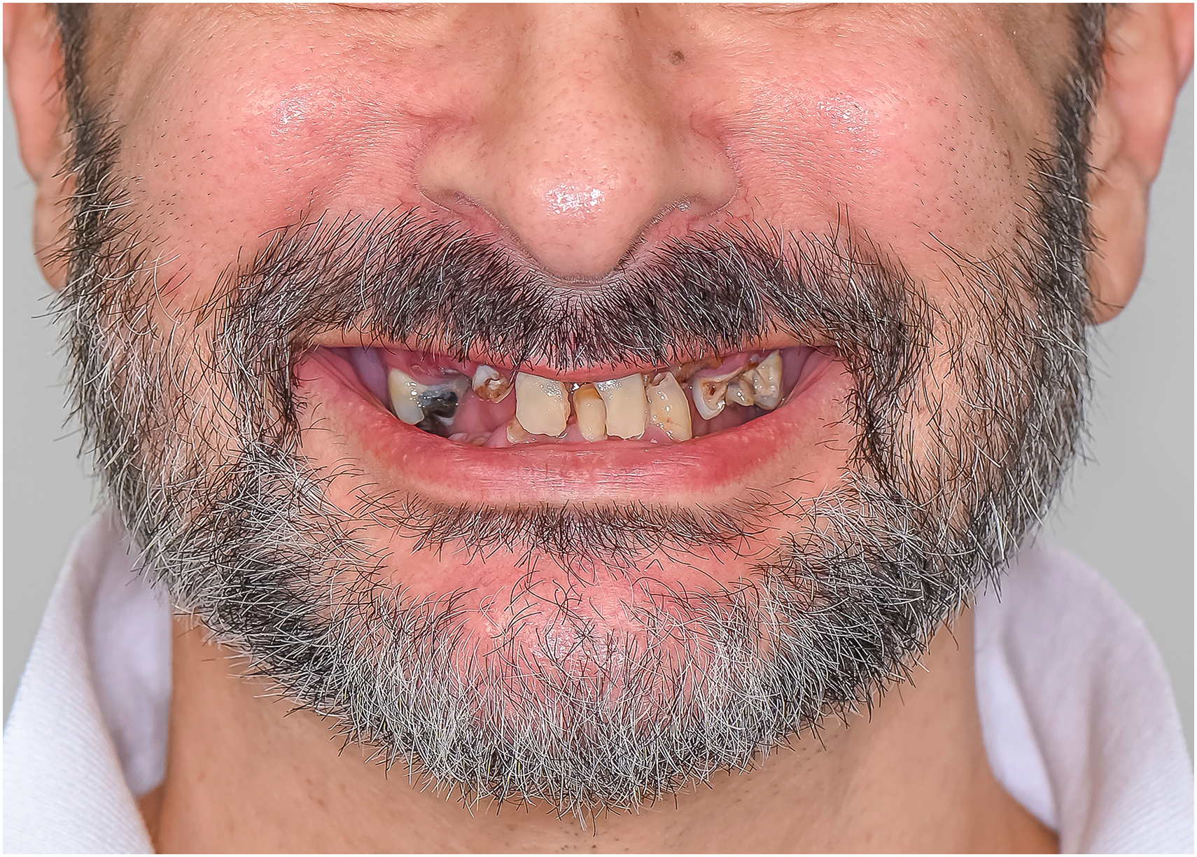 A clinical photo shows a pre-operative smile with excessive gum display on the right, supraeruption of the premolar, and a sinus position necessitating a larger alveolectomy and Sinus Crush.