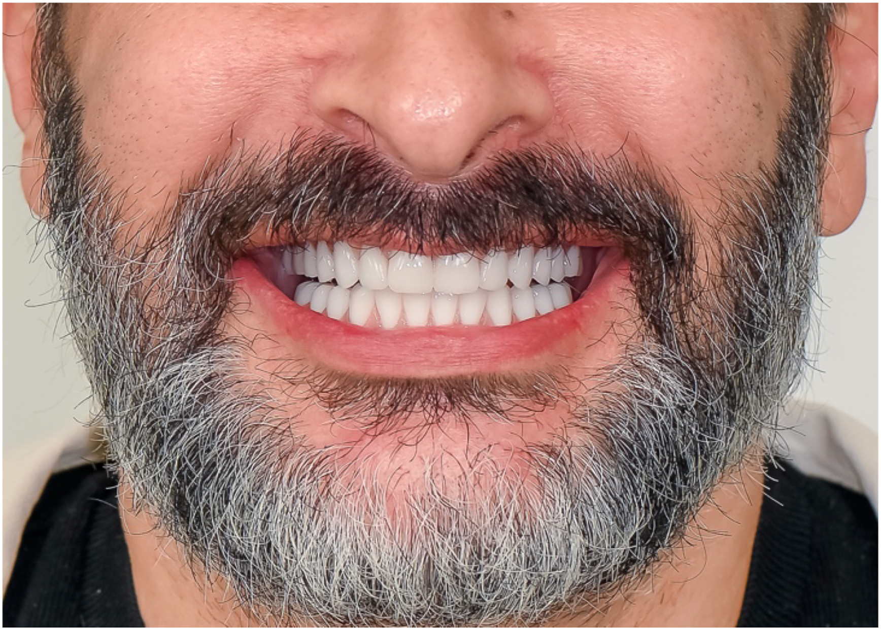 A clinical photo shows a final result with Immediate Final Teeth inserted within twenty-four hours, displaying a complete set of teeth in a mans smile.