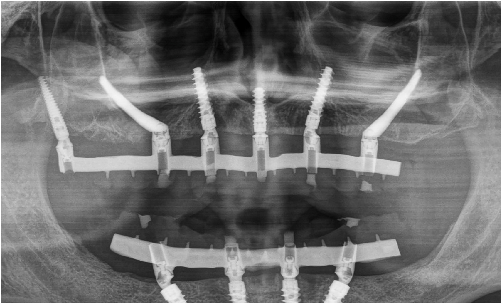 A radiographic image shows post-op use of Piriform and midline implants for anterior support, a Pterygoid implant on the left, and a zygomatic implant unsupported at the crest.