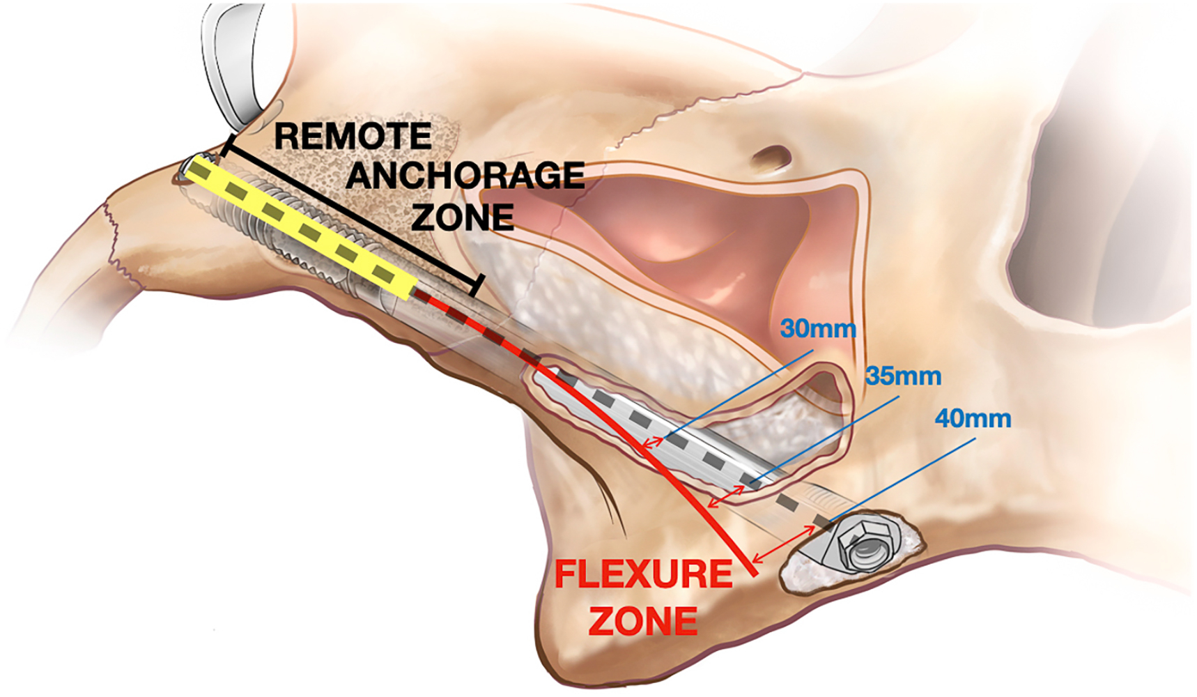Cutaway skull illustration shows zygomatic implant extending through sinus cavity, with remote anchorage zone, flexure zone, and measured distances labeled along the implant body.