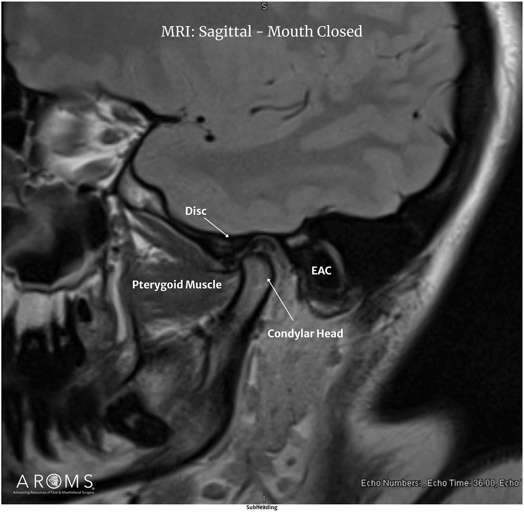 Alt text begins. An M R I of the temporomandibular joint in sagittal view with mouth closed features labeled disc, condylar head, external auditory canal, and pterygoid muscle. Alt text provided by Elsevier.