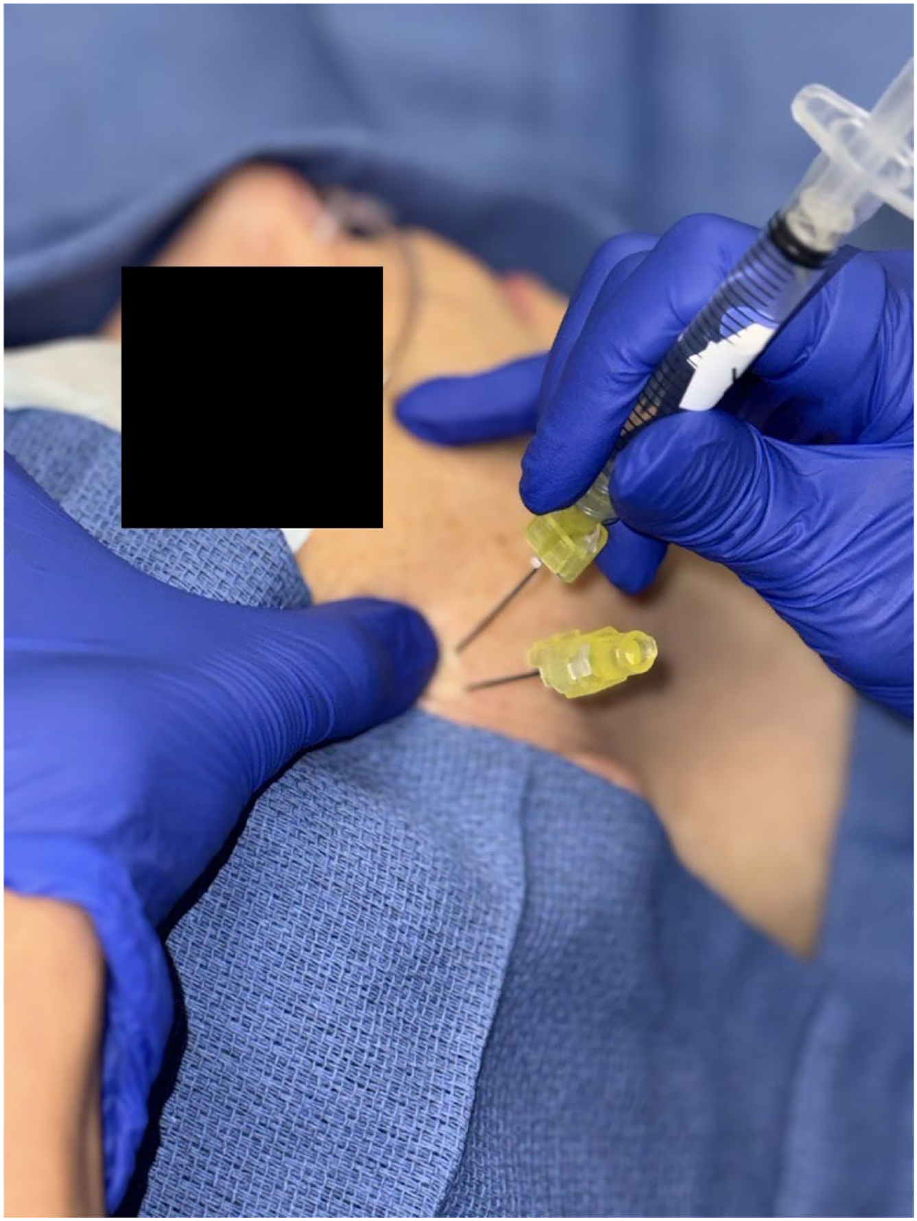Alt text begins. A photograph depicts gloved hands performing anterior port placement with 1 needle already inserted near the ear, while a second needle attached to a syringe is advanced into the lateral facial region. Alt text provided by Elsevier.