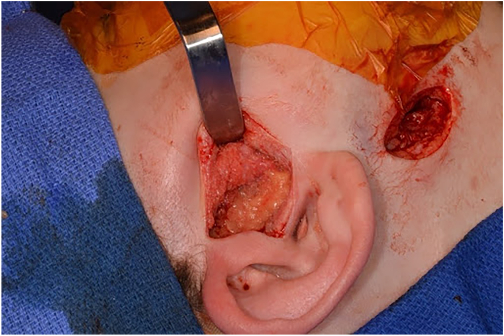 Alt text begins. A surgical photograph shows the preauricular incision held open by retractors with the harvested autologous fat graft fully packed into the site around the prosthesis. Alt text provided by Elsevier.