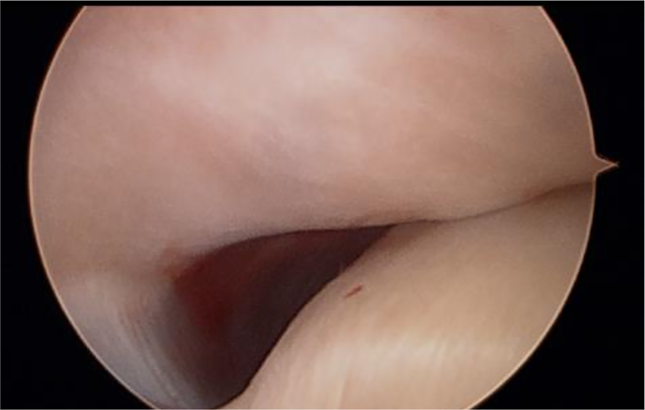 Alt text begins. An arthroscopic image of an intra-articular cavity illustrating the posterior slope of the articular eminence and glenoid fossa in a temporomandibular joint procedure. Alt text provided by Elsevier.
