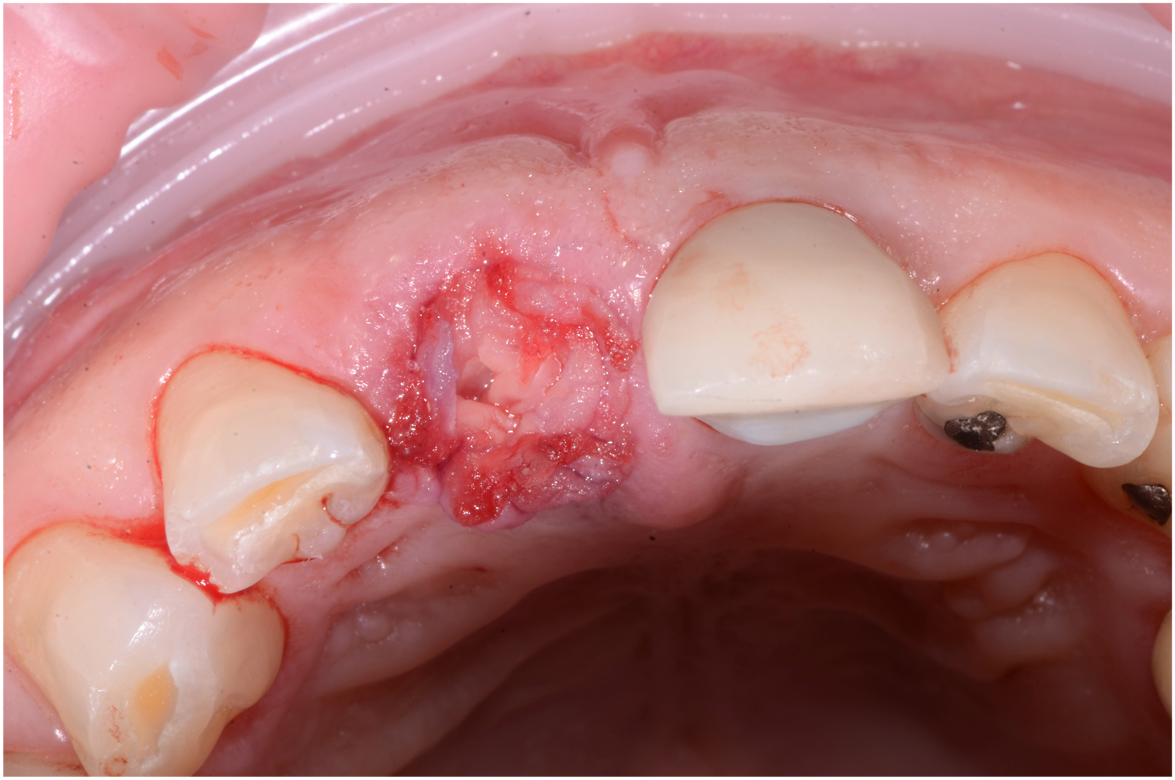 An occlusal view of the upper front tooth region after surgery, where the socket area is closed with a membrane, and it shows the surrounding gingival tissue and adjacent teeth.