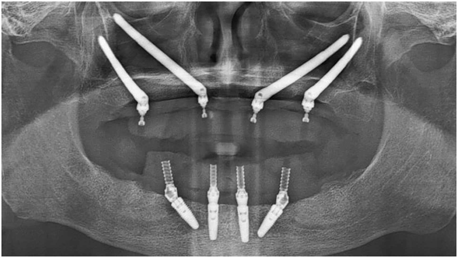A radiographic image shows a patients upper jaw with four zygomatic implants placed, including two long and two short implants.