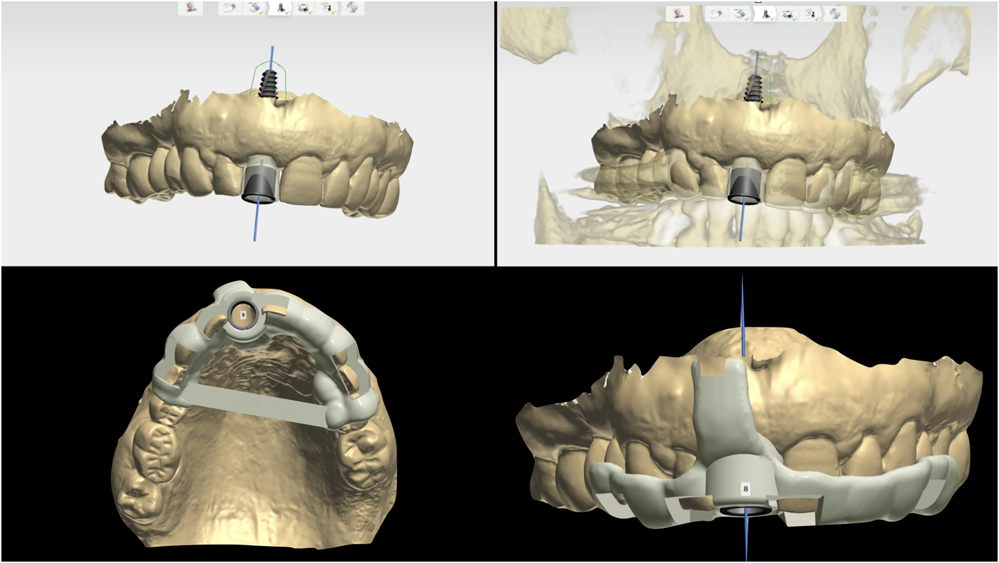 A set of four digital panels shows a 3 D dental model with an implant and guide placement.