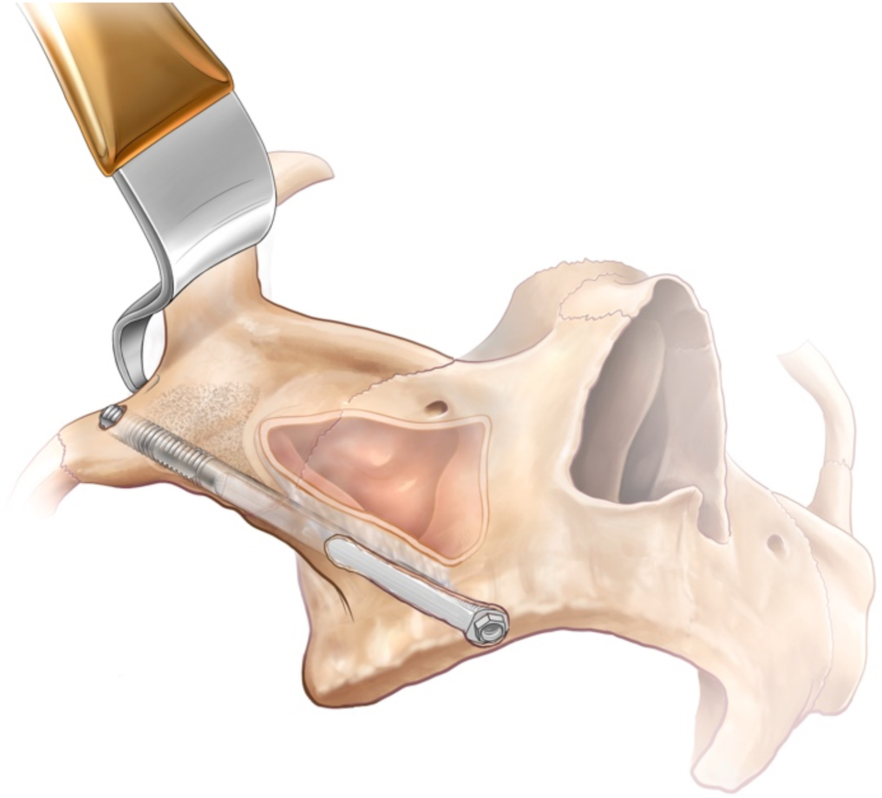 Cutaway skull illustration shows implant trajectory from upper jaw toward cheekbone through narrow superior bone slot, soft tissue elevated, and implant axis aligned with prosthetic access direction.
