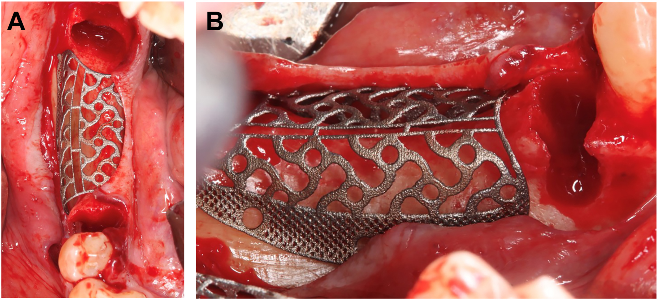 A two-part surgical view of mandibular extraction sockets at positions 29 and 32 with a titanium mesh placed over the bone defect and secured with sutures.