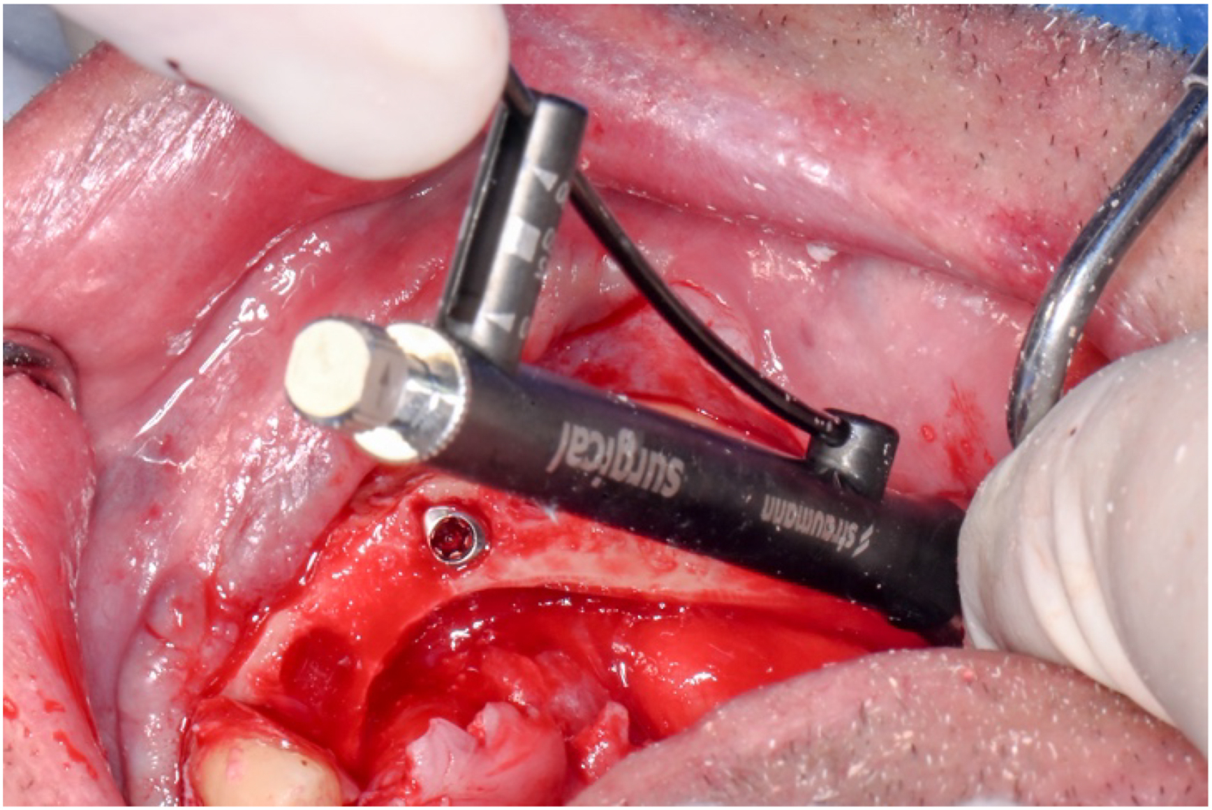 A clinical photo shows a Straumann B L X torqued to 80 newton-centimeters, with a metal instrument and screw visible in the surgical site.