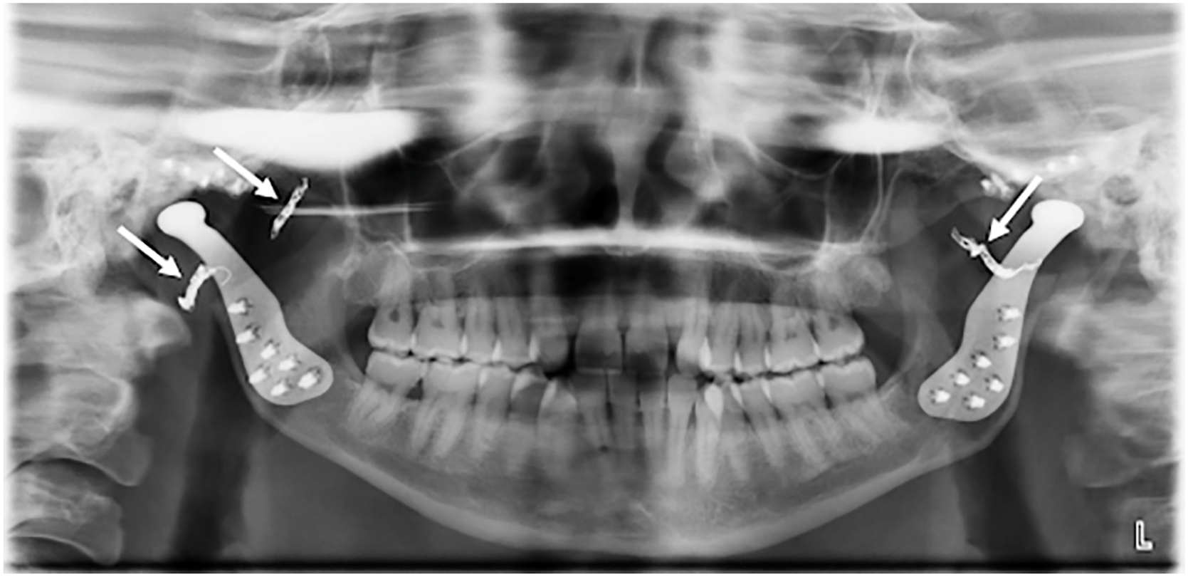 Alt text begins. A panoramic radiograph shows bilateral temporomandibular joint prostheses and platinum embolization coils in the bilateral internal maxillary arteries, indicated by arrows. Alt text provided by Elsevier.