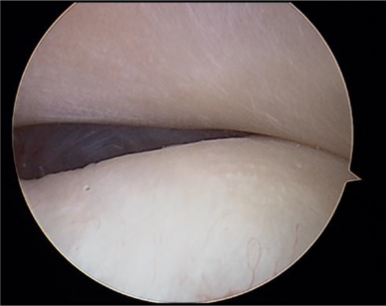 Alt text begins. An arthroscopic image of an intra-articular cavity illustrating the articular disc positioned between opposing joint surfaces in a temporomandibular joint procedure. Alt text provided by Elsevier.