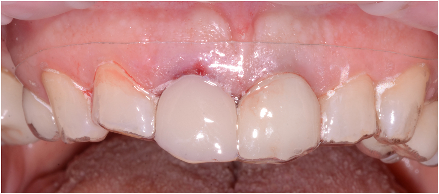 A frontal intraoral view shows the upper teeth covered by a transparent Essix retainer with the gum line above and the tongue surface below.