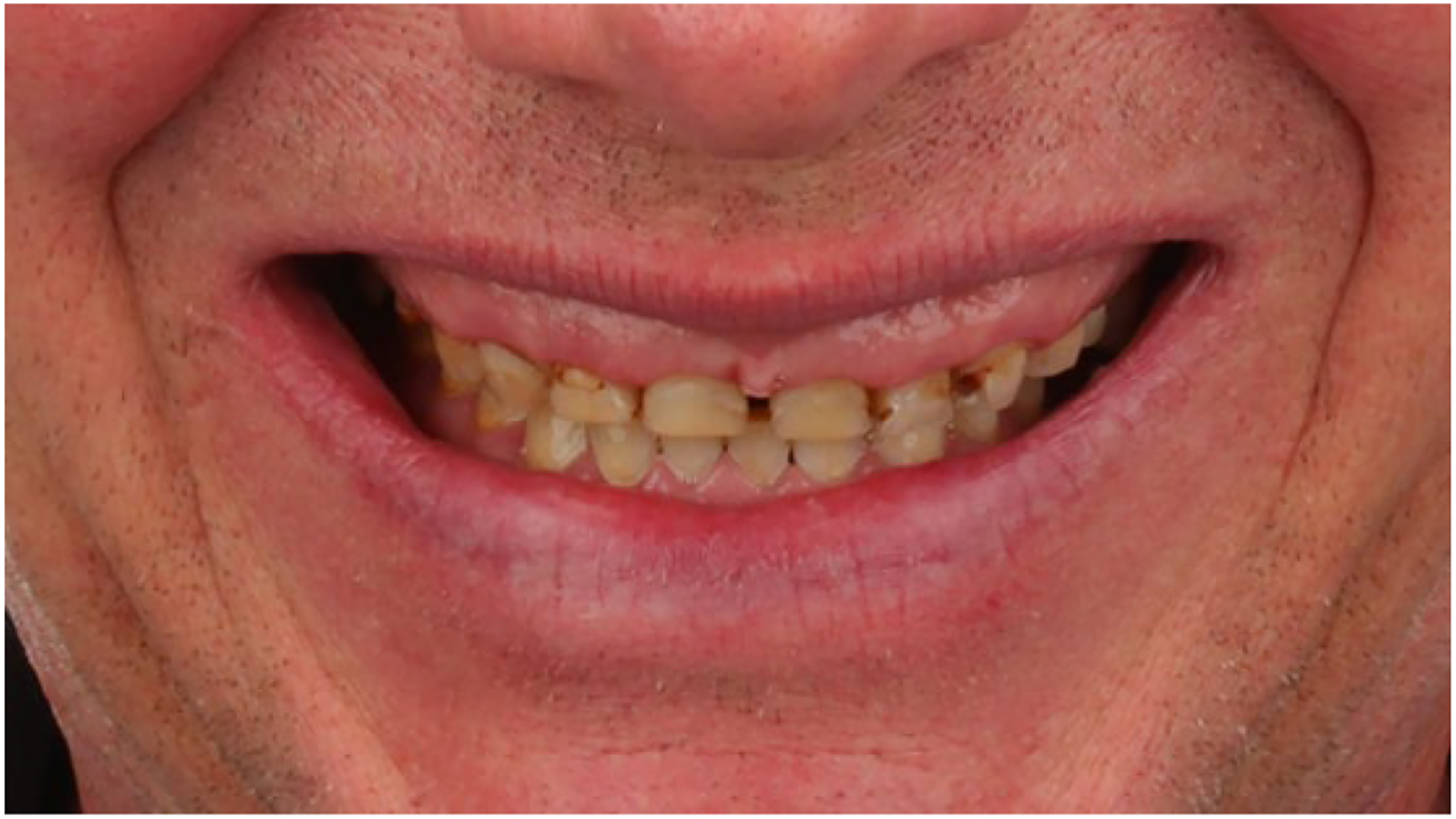 A clinical photo shows a patient smiling with upper front teeth and gums, revealing a high smile line.