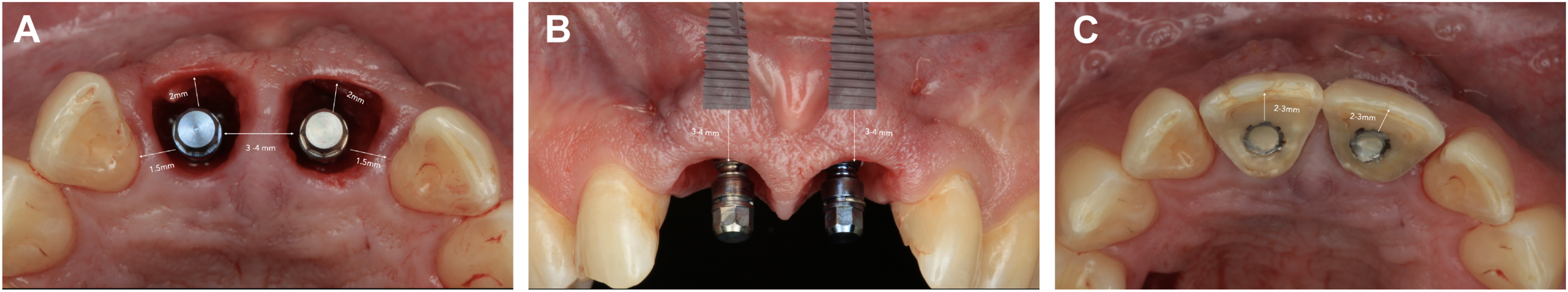 A set of three dental views shows implant placement in the upper front region with healing abutments.