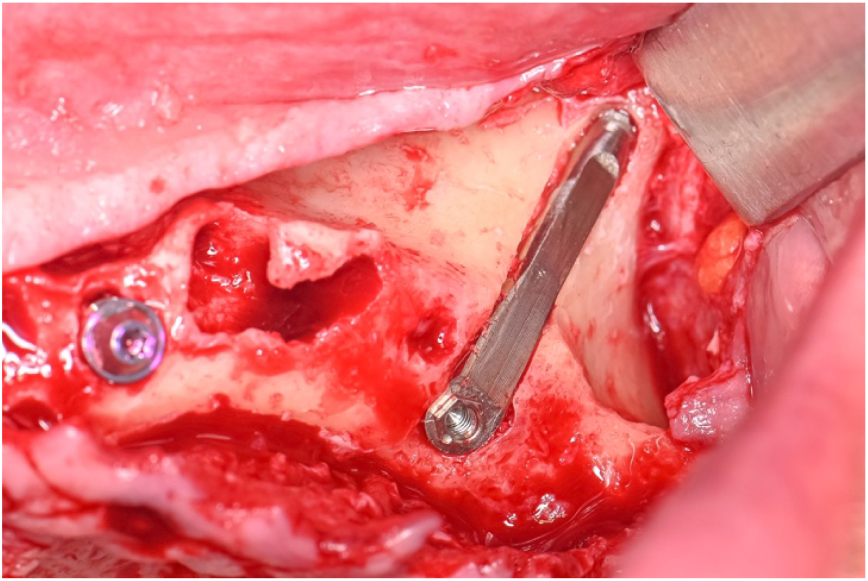 A photo of a surgical site with a vertical slot and an implant in the zygoma.