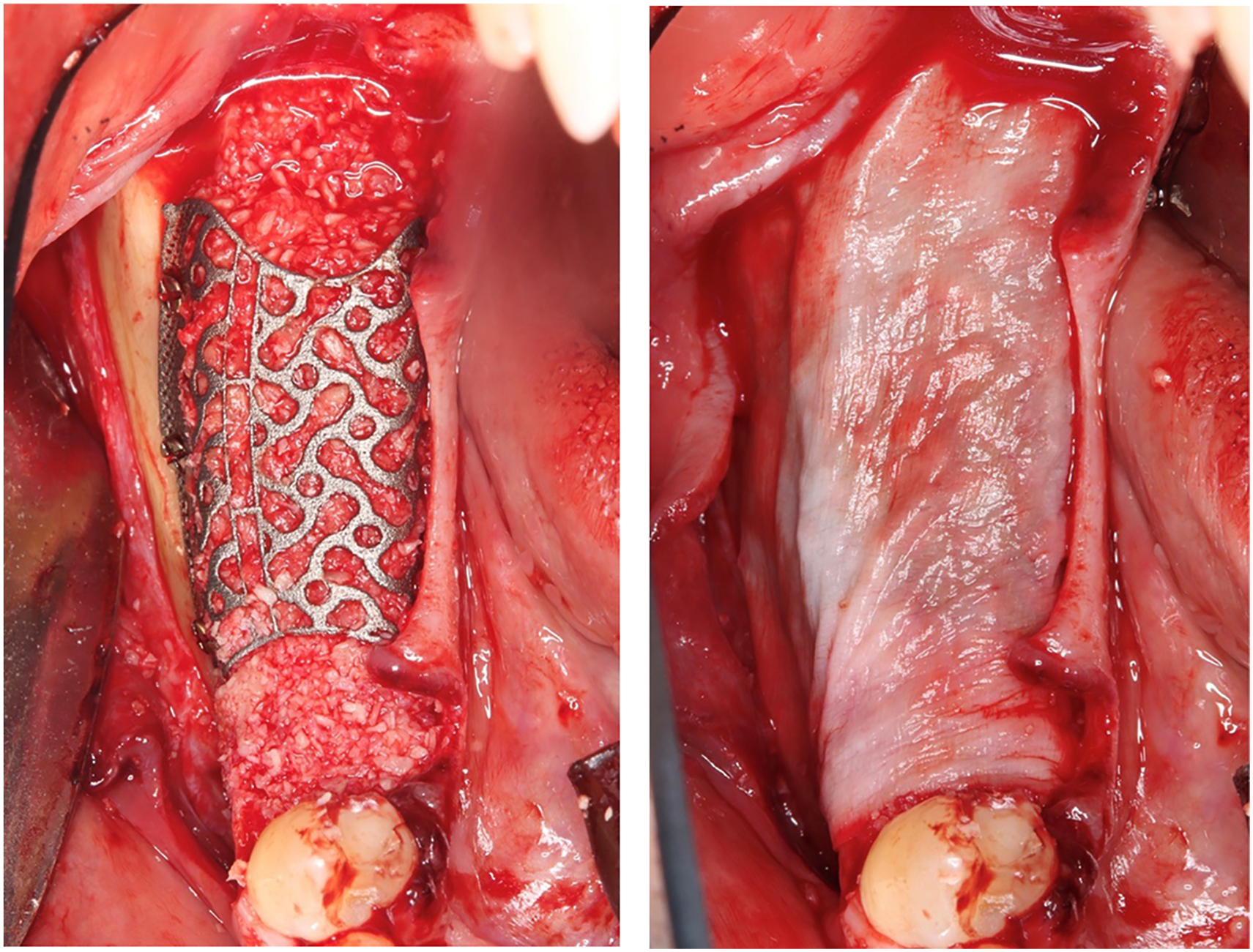 A set of two panels shows a customized mesh fitted over a mandibular bone defect and covered by repositioned soft tissue.