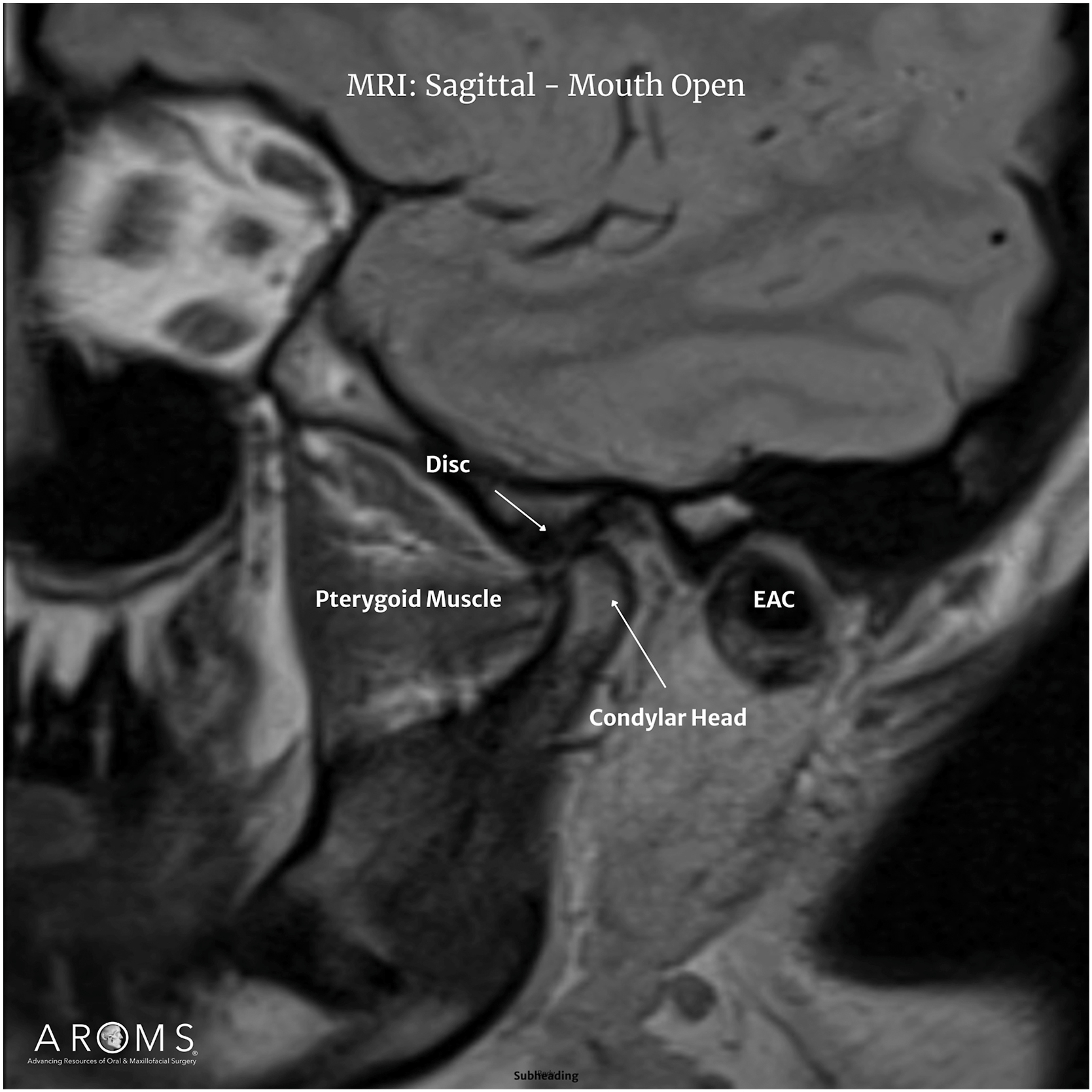 Alt text begins. An M R I of the temporomandibular joint in sagittal view with mouth open, with labeled disc, condylar head, external auditory canal, and pterygoid muscle. Alt text provided by Elsevier.