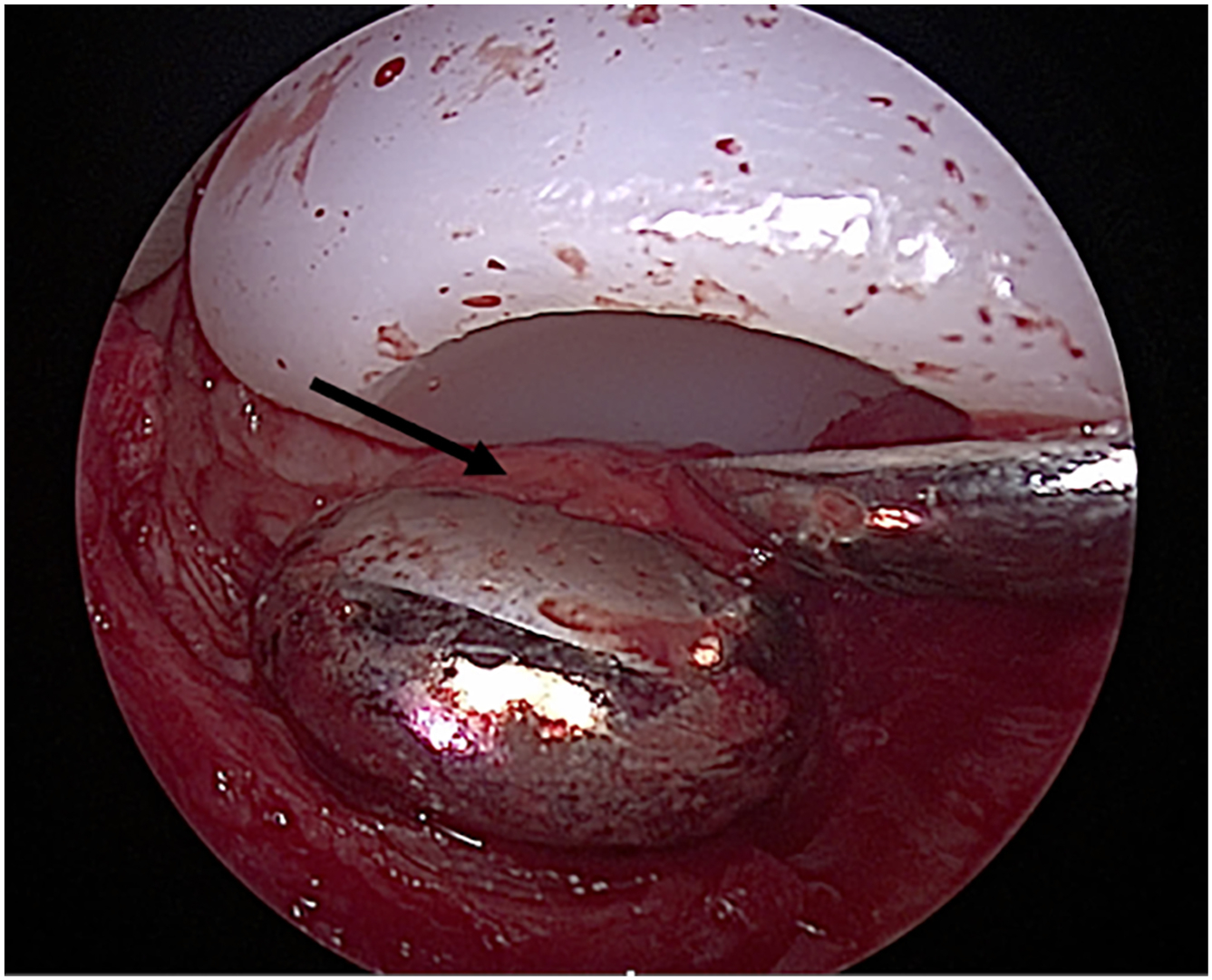 Alt text begins. A close-up arthroscopic view shows soft tissue ingrowth indicated by an arrow between the artificial articulating surfaces of a temporomandibular joint total joint replacement. Alt text provided by Elsevier.