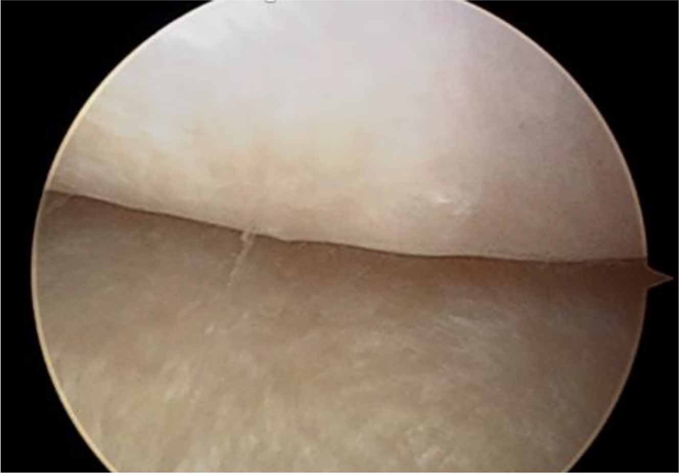 Alt text begins. An arthroscopic image of an intra-articular cavity illustrating the intermediate zone between opposing joint surfaces in the temporomandibular joint procedure. Alt text provided by Elsevier.