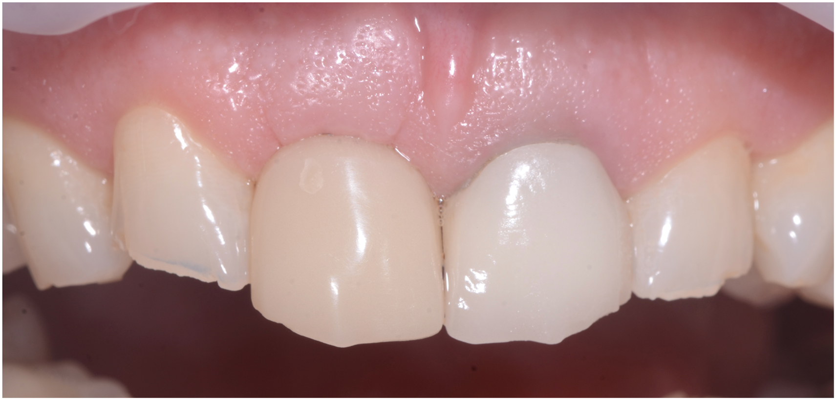 An anterior view of upper front teeth with a newly placed provisional crown that aligns with the surrounding teeth and gum line.