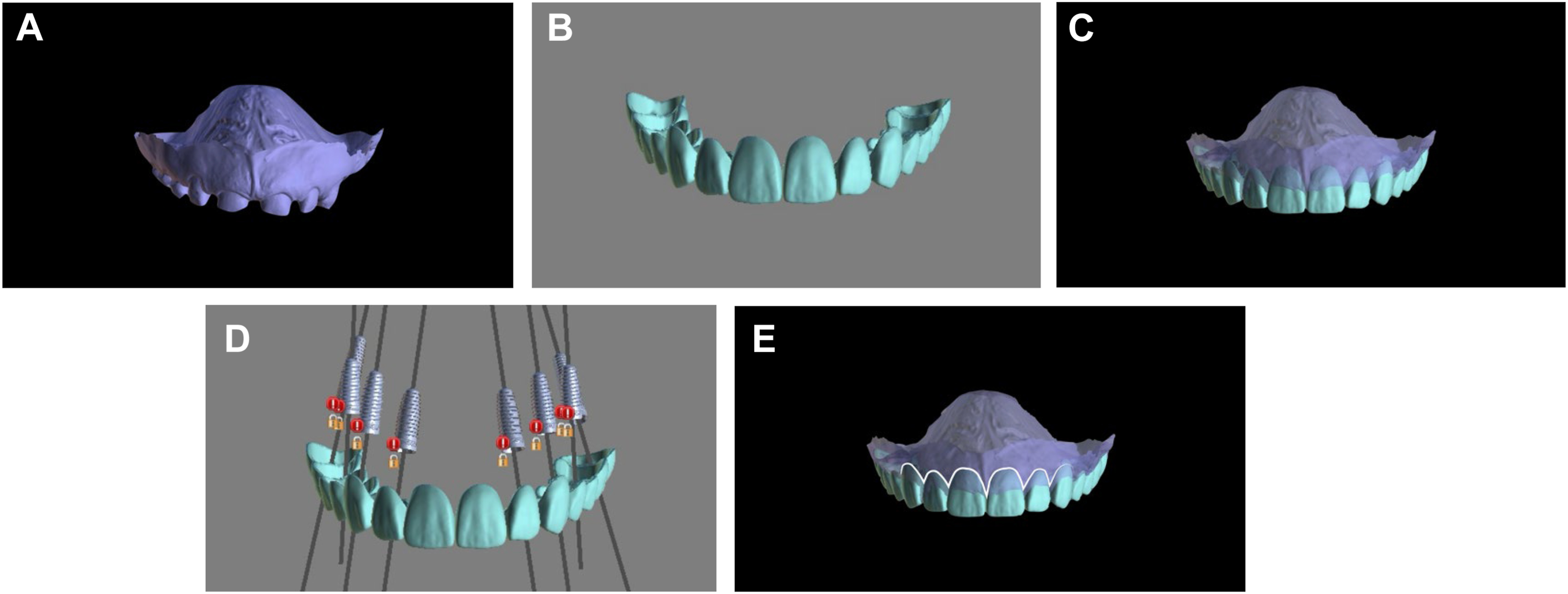 A composite illustration shows an intraoral jaw scan for reference, a diagnostic waxup of teeth, a merged scan and waxup, proposed implant positions, and bone reduction areas.