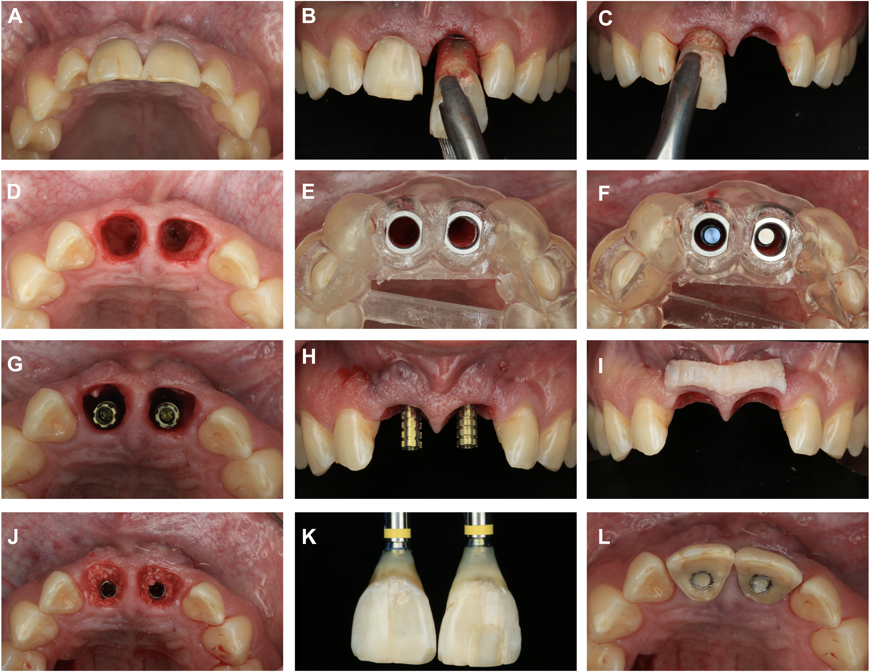 A set of twelve dental panels shows extraction, implant placement, grafting, and restoration of two upper front teeth.