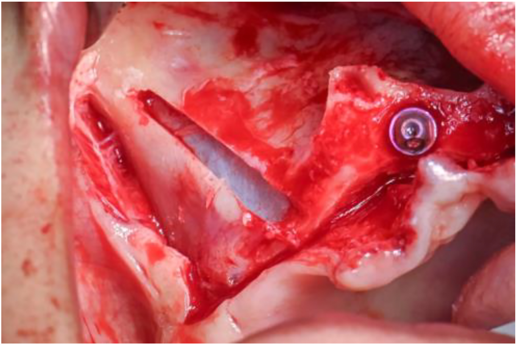 A photo of a surgical site with a slot and an implant isolating a membrane.