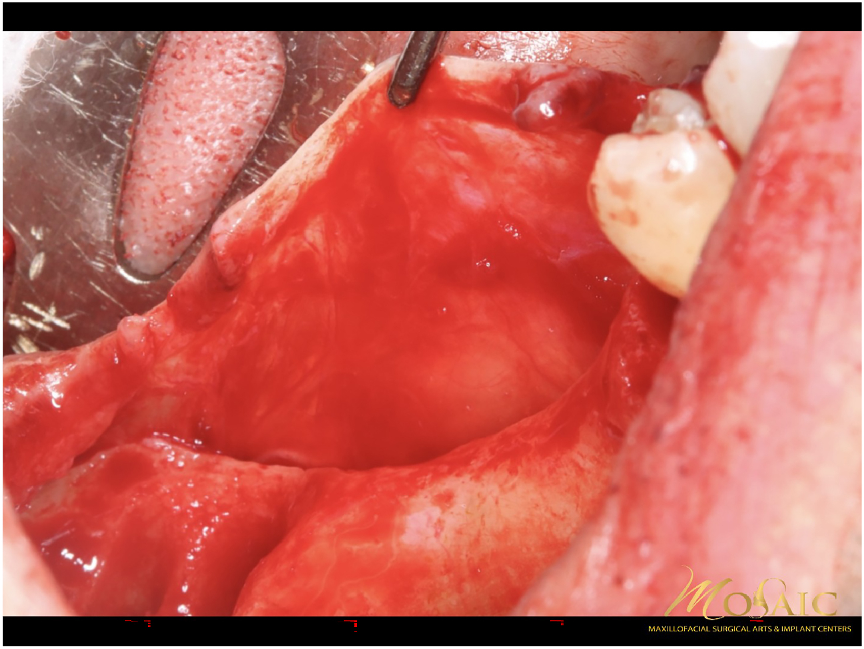 An intraoral surgical view shows the exposed bone surface and adjacent tooth after soft tissue reflection, prepared for mesh positioning with predrilled fixation holes.