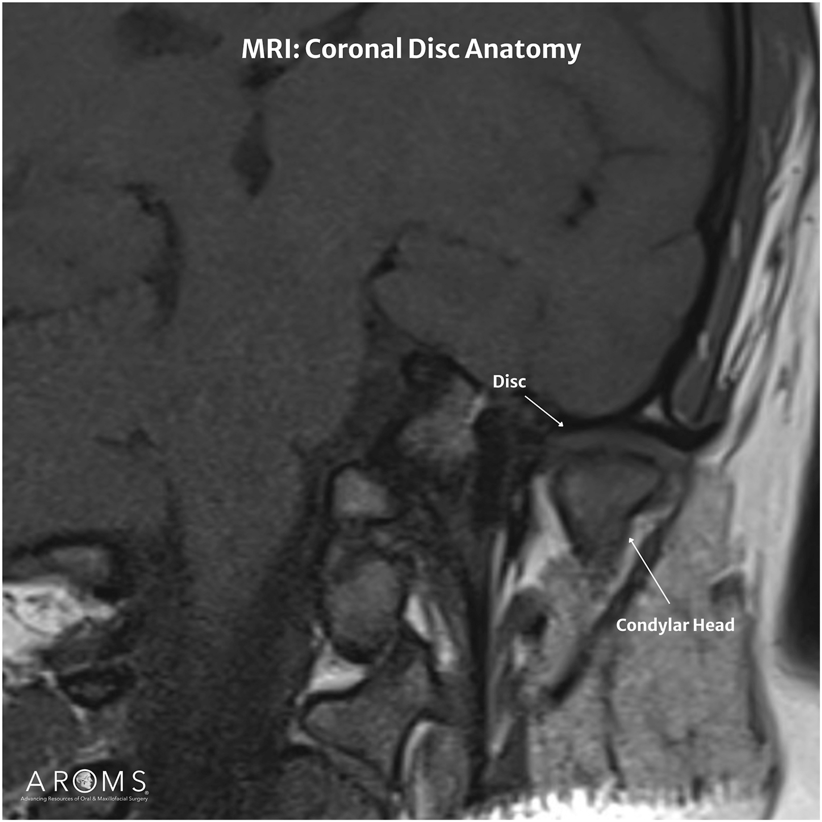 Alt text begins. An M R I of the temporomandibular joint in coronal view with the mouth closed, with the labeled disc and condylar head. Alt text provided by Elsevier.