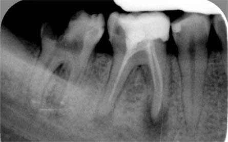 A) Preoperative intraoral periapical (IOPA) radiograph of 36. B