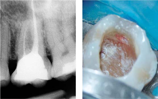 43 Perforations Pocket Dentistry