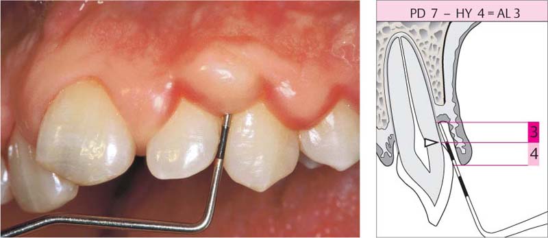 Deep pocket depths (≥ 7mm), bleeding on probing on mesial aspect of an