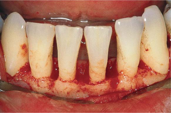 calculus bridge teeth removal