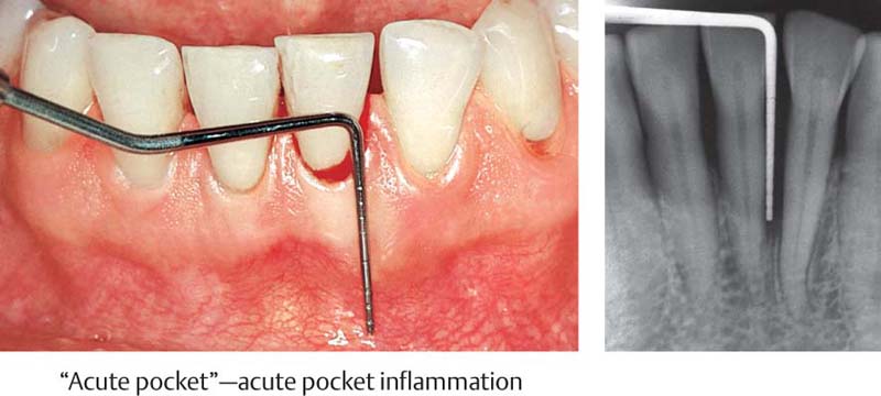 Therapy  Pocket Dentistry