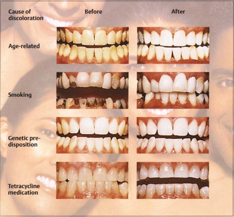 bleaching-pocket-dentistry