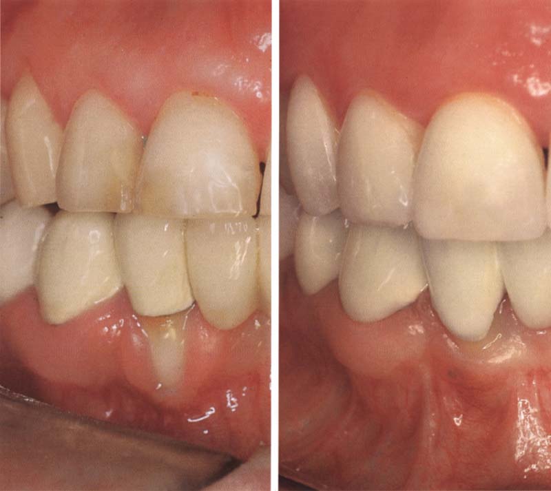 Aesthetic Periodontal Surgery | Pocket Dentistry