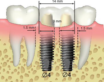 Dental implants: Mandibular neurovascular considerations 