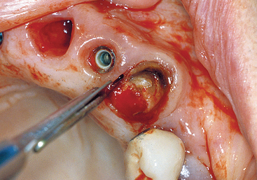 tooth fragments left after extraction