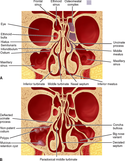 Maxillary Sinus Anatomy