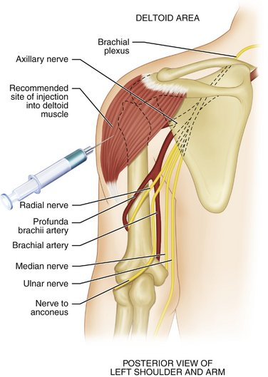 10 Intramuscular Sedation Pocket Dentistry 10 Intramuscular Sedation Pocket Dentistry