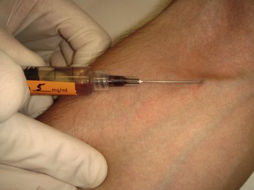 iv sedation needle