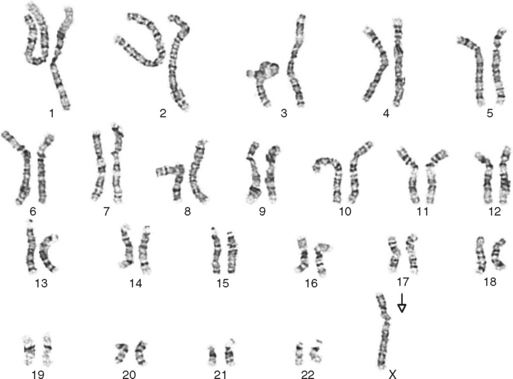 achondroplasia karyotype chromosome 4