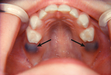 Eruption Cyst