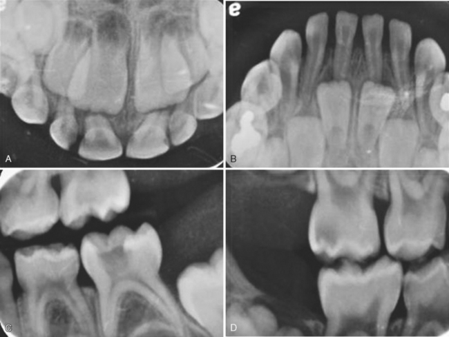 Mean scores for dental caries in the mandibu- lar molars of each group.