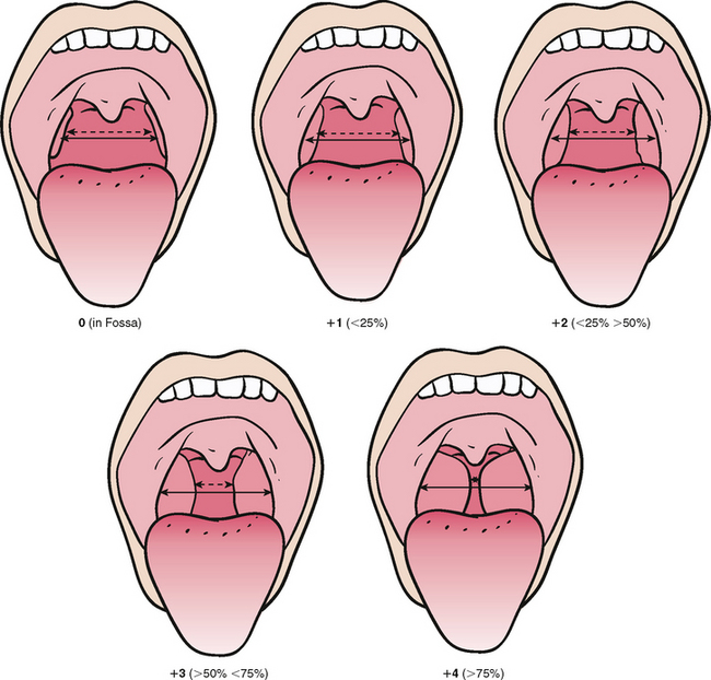 Tonsil Chart