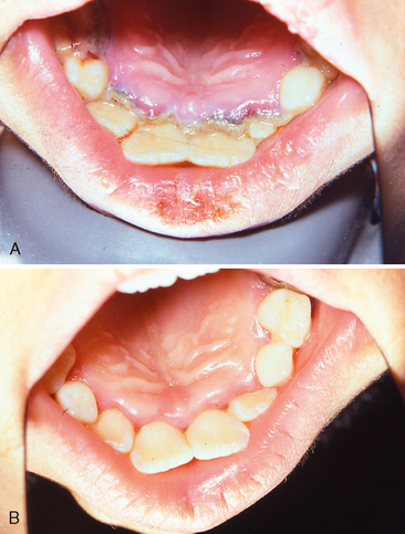 Treatment Of Herpes Simplex Labialis With Stannous Fluoride Gel