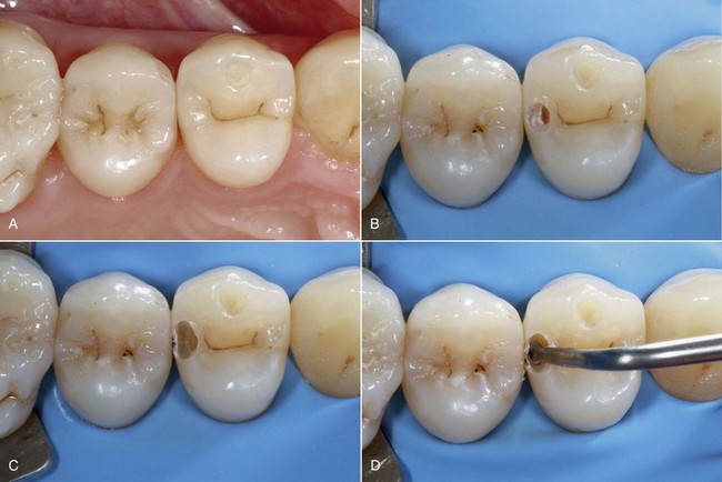 Slot prep dental