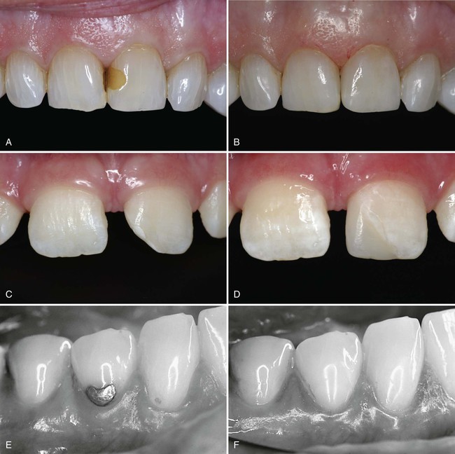 Composite build up protocols for complex class IV cavities with