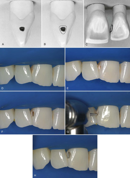 Composite build up protocols for complex class IV cavities with